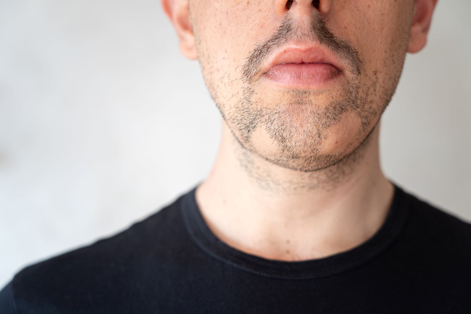 Dermatologie, la pelade barbe : qu'est ce que c'est, les ...